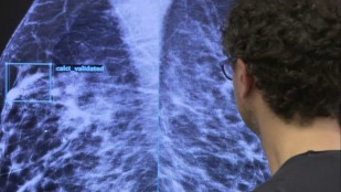 Dépistage du cancer : la révolution de l'intelligence artificielle